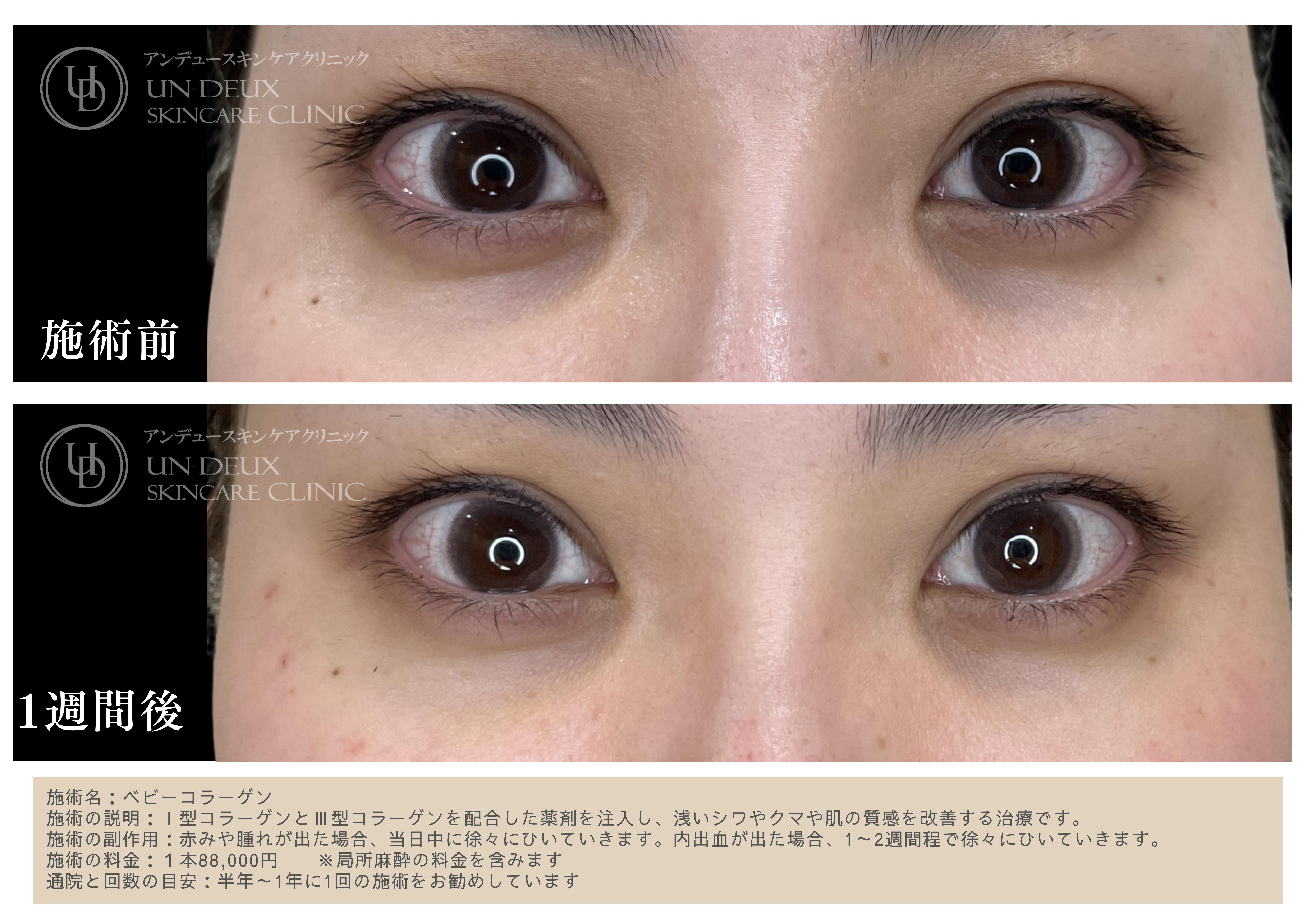 ベビーコラーゲン症例④.png